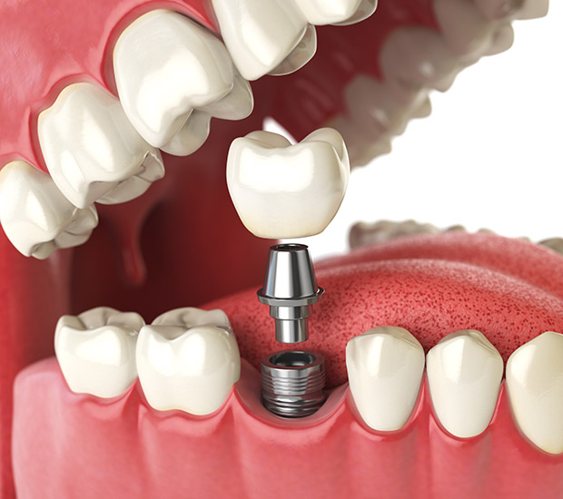 Los Alamitos Will I Need a Bone Graft for Dental Implants