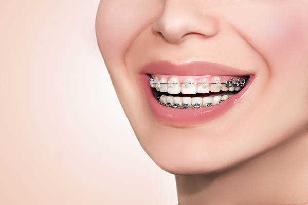Proper Care For Clear Braces