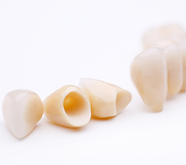 Los Alamitos Dental Crowns and Dental Bridges