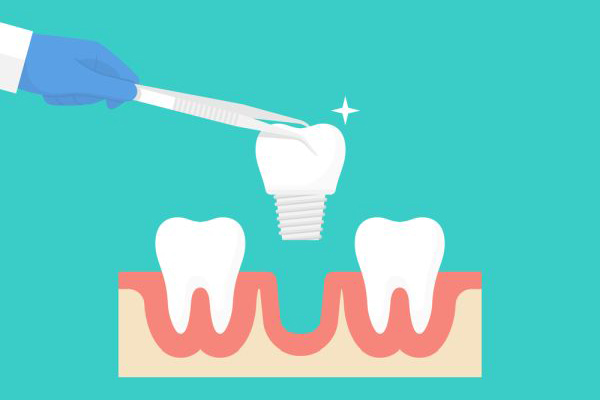 dental implant Los Alamitos, CA