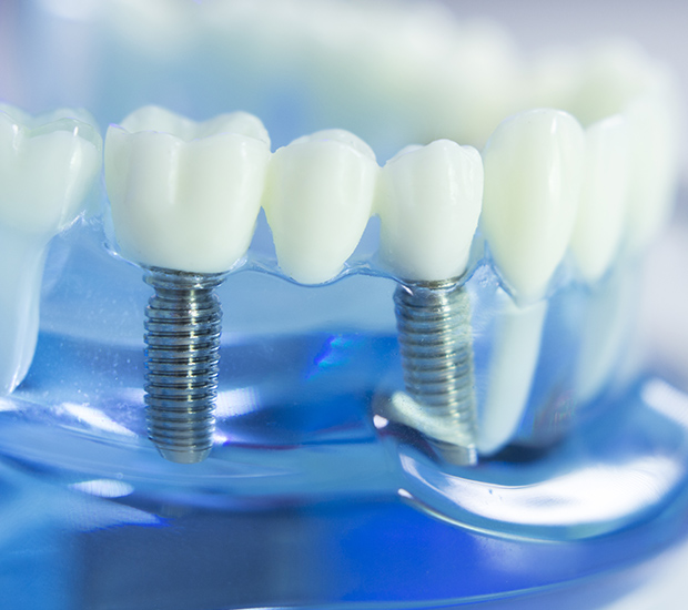 Los Alamitos Dental Implants