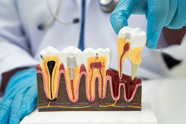 Possible Complications Of Root Canals And How To Avoid Them